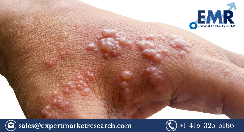 Read more about the article Global Bullous Pemphigoid Treatment Market to be driven by the increasing geriatric population in the Forecast Period of 2023-2028