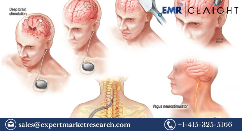 Read more about the article Neuromodulation Devices Market to be Driven by Rising Chronic Pain Patients in the Forecast Period of 2023-2031