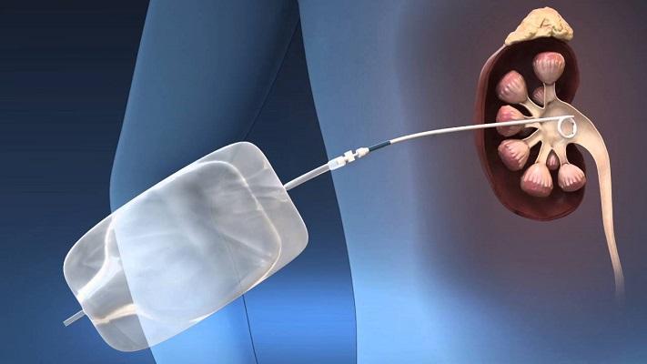 Read more about the article Global Nephrostomy Devices Market to be Driven by the Increased Popularity of Minimally Invasive Treatment in the Forecast Period of 2021-2026