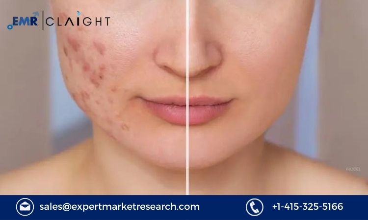 Read more about the article Global Scar Treatment Market to be Driven by Growing Concern among People regarding their Aesthetic Appeal in the Forecast Period of 2024-2032