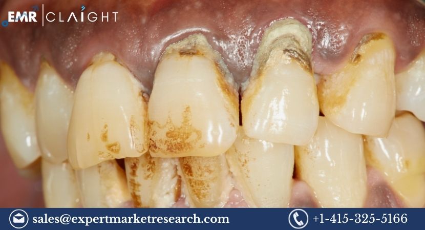 Read more about the article Global Periodontal Therapeutics Market to be Driven by Increasing Incidences of Periodontal Diseases Globally in the Forecast Period of 2024-2032