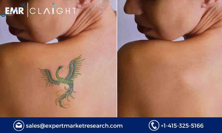 Read more about the article Global Tattoo Removal Market to be Driven by the Growing Popularity of Laser Surgeries in the Forecast Period of 2024-2032