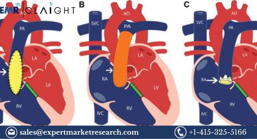 Read more about the article Global Transcatheter Pulmonary Valve Market to be Driven by the Increasing Prevalence of Congenital Heart Disease in the Forecast Period of 2024-2032