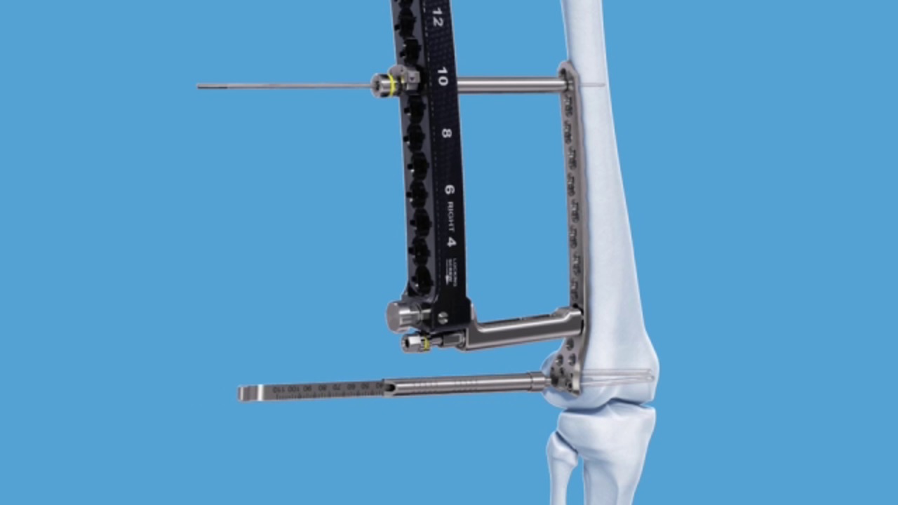 Read more about the article Global Condylar Plate Fixation System Market to  be  Driven  by the Rising Incidence of Traumatic Injuries in the Forecast Period of 2022-2027