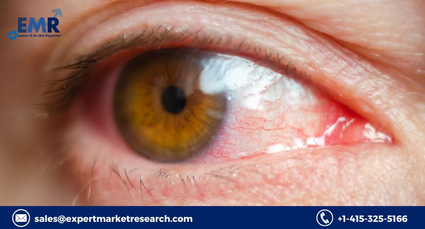 You are currently viewing Global Anti-Infectives Market to be Driven by the Increasing Prevalence of Eye Infections in the Forecast Period of 2024-2032