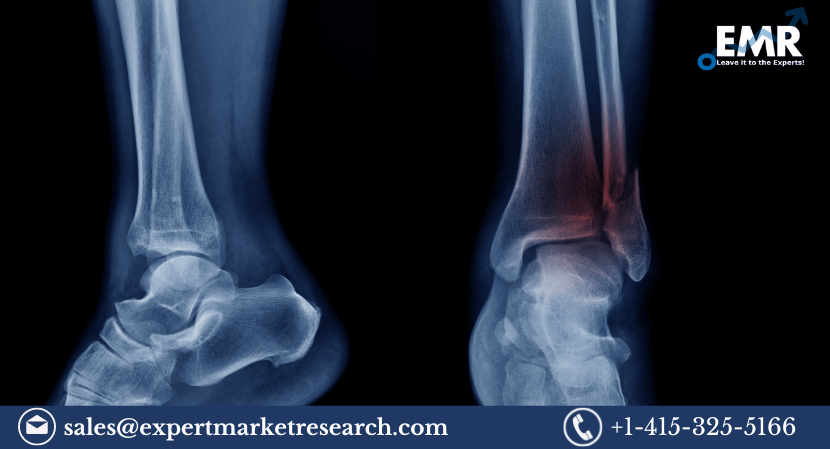 Read more about the article Global Non-Union Fractures Market to be Driven by the Increasing Prevalence of Non-Union Fracture in the Forecast Period of 2023-2028