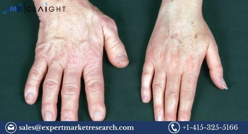 Read more about the article Global Acromegaly Treatment Market Size to Grow at a CAGR of 7.65% in the Forecast Period of 2024-2032