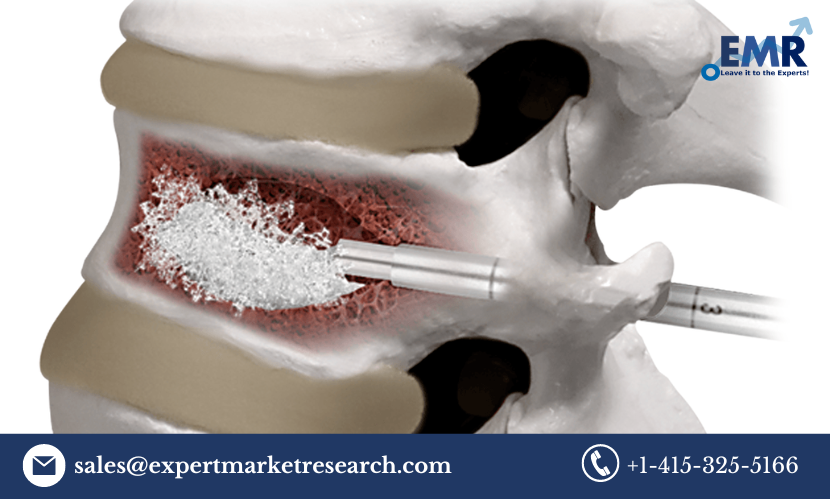 Read more about the article Europe Bone Cement Market Size to Grow at a CAGR of 6.1% in the Forecast Period of 2023-2031