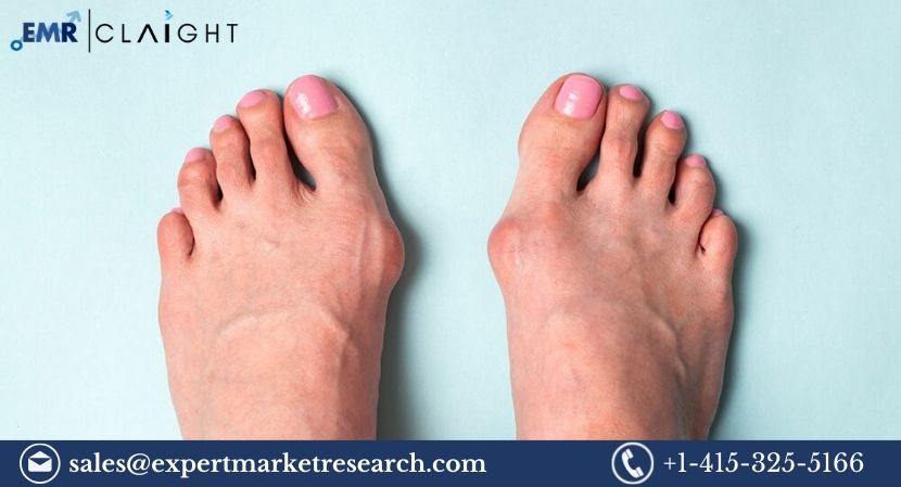 Read more about the article Global Hallux Valgus Treatment Market Size to Grow at a CAGR of 5.90% During the Forecast Period of 2024-2032