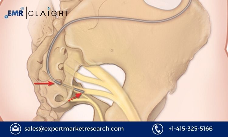 Read more about the article Sacral Nerve Stimulation Market Size to Grow at a CAGR of 12.50% in the Forecast Period of 2024-2032