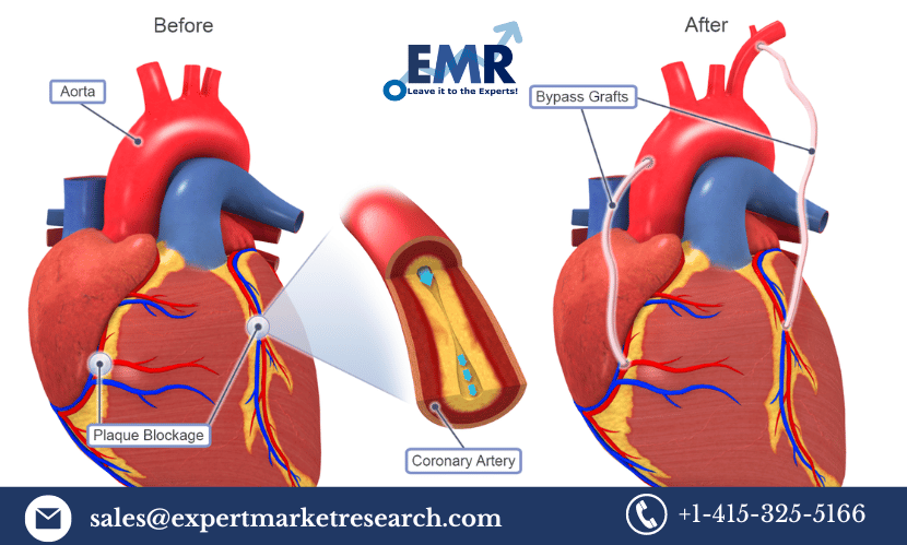Read more about the article Global Coronary Artery Bypass Graft Procedures Market Size, Growth, Analysis, Demand, Forecast 2023-2028