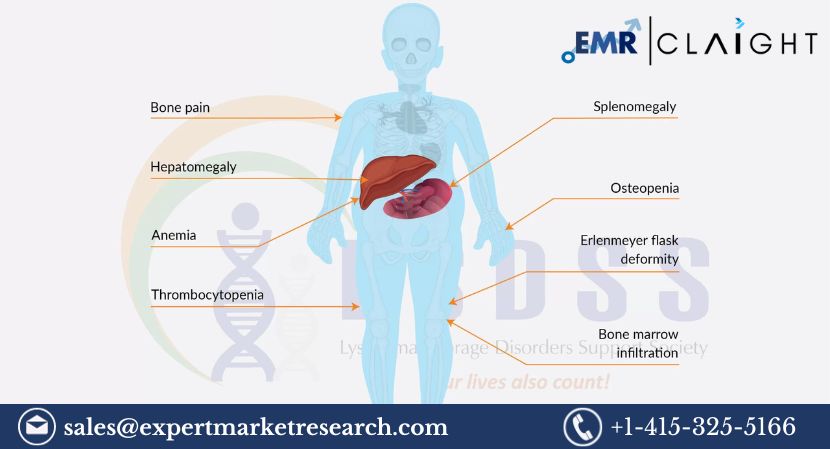 Read more about the article Gaucher’s Disease Treatment Market Size to Increase at a CAGR of 3.6% in the Forecast Period of 2024-2032