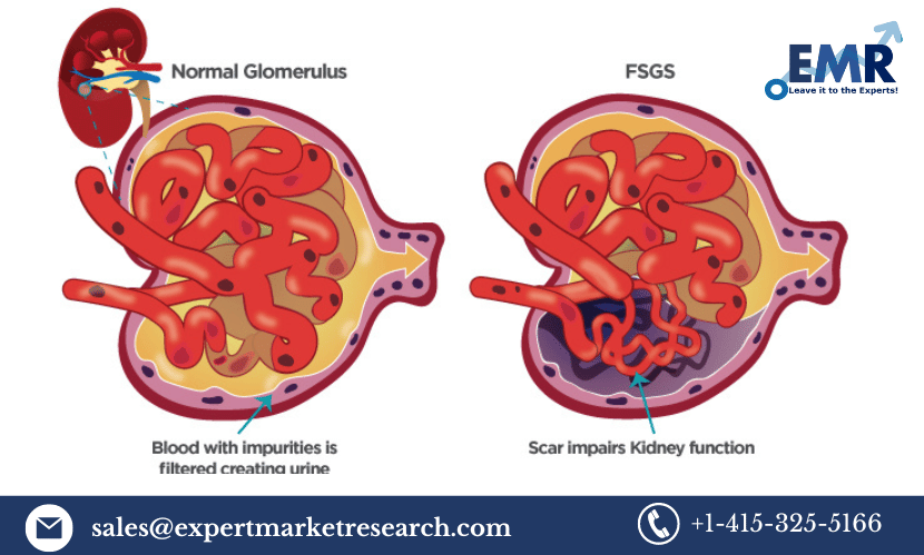 Read more about the article Global Focal Segmental Glomerulosclerosis (FSGS) Treatment Market Size to Grow at a CAGR of 8.25% in the Forecast Period of 2024-2032