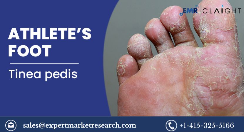 Read more about the article Global Athlete’s Foot Treatment Market Report Size to Grow at a CAGR of 7% During the Forecast Period of 2024-2032