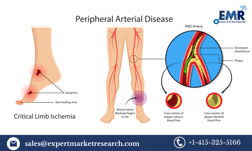 Read more about the article Peripheral Artery Disease Market Size, Share, Price, Growth, Trends, Analysis, Report, Demand, Research, Forecast 2024-2032