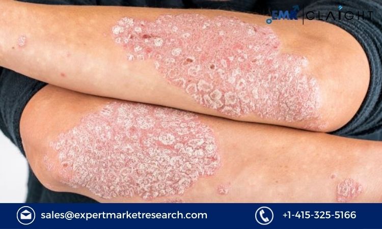 Read more about the article Global Plaque Psoriasis Treatment Market Size to Grow at a CAGR of 3% During the Forecast Period of 2024-2032