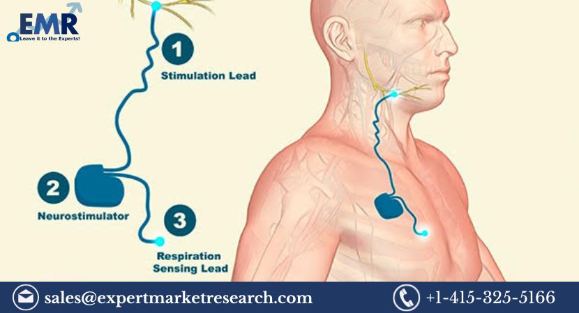 Read more about the article Global Hypoglossal Nerve Stimulation Therapy Market Report and Forecast 2024-2032