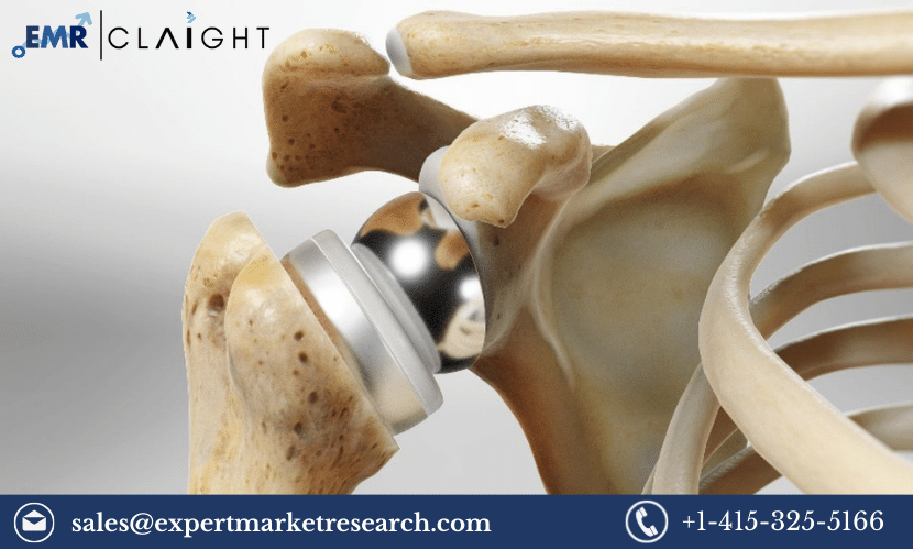 Read more about the article Global Shoulder Replacement Market Share, Size, Price, Analysis, Outlook, Research Report and Forecast 2024-2032