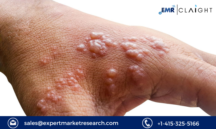 Read more about the article Bullous Pemphigoid Treatment Market Size, Share, Analysis Report and Forecast 2024-2032