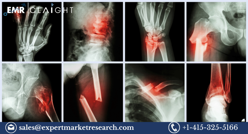 Read more about the article Global Non-Union Fractures Market Size To Grow At A CAGR Of 7.5% In The Forecast Period Of 2024-2032