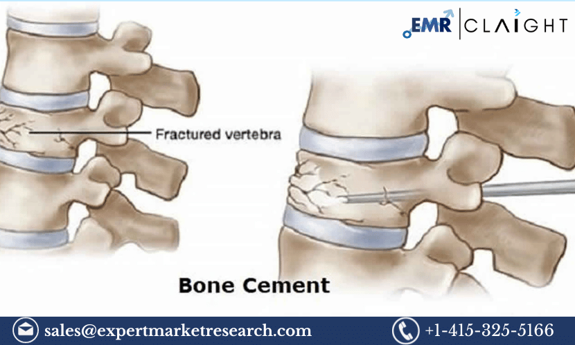 Read more about the article Europe Bone Cement Market Size, Share, Growth, Trends, Demand, Analysis, Key Players, Report, Forecast 2024-2032