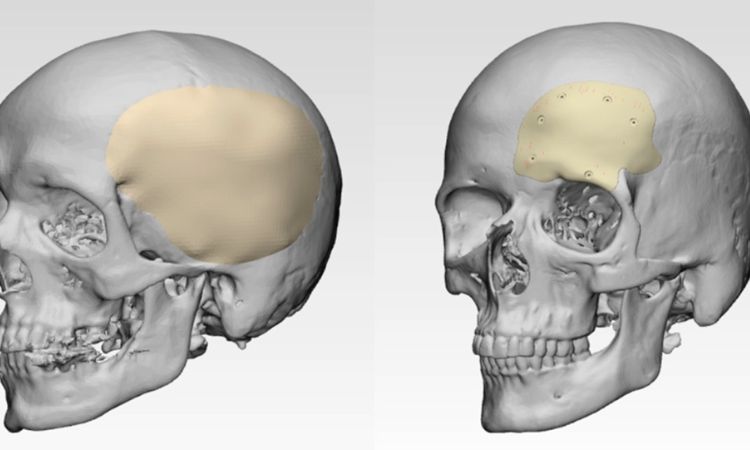 Read more about the article Global Cranial Implants Market Size, Share, Report and Forecast 2024-2032