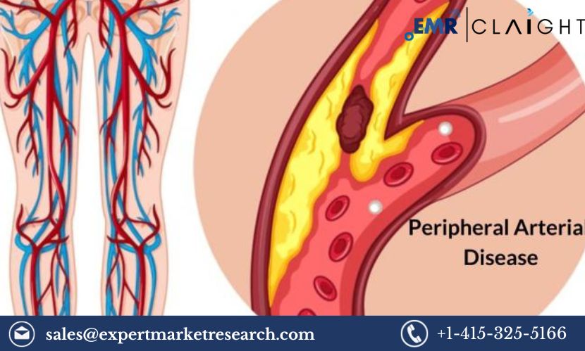 Read more about the article Global Peripheral Artery Diseases Market Size, Share, Price, Trends, Growth, Analysis, Report and Forecast 2024-2032