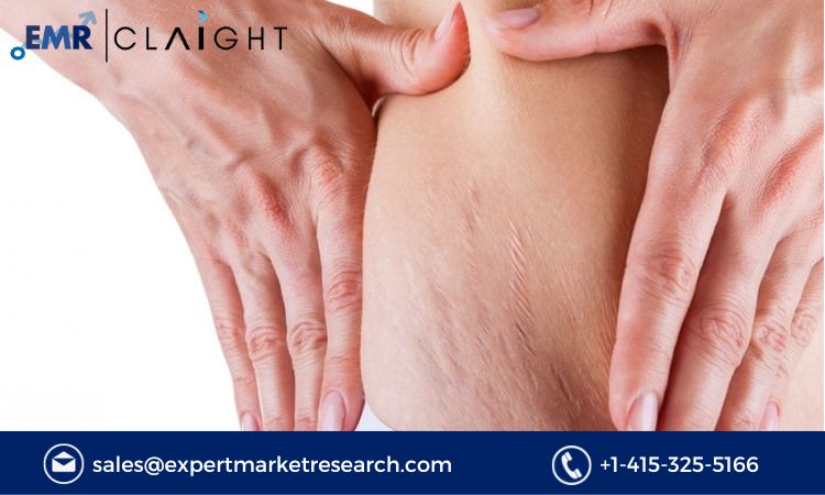 Read more about the article Global Stretch Marks Treatment Market Size, Share, Report and Forecast 2024-2032