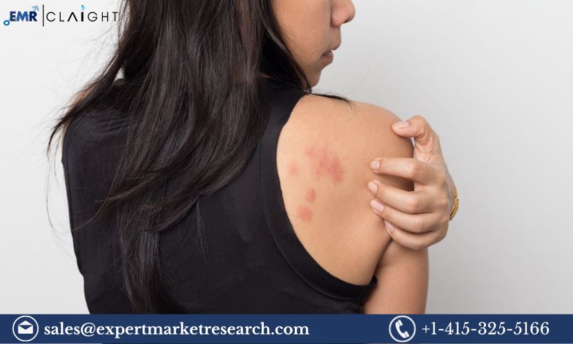 Read more about the article Chronic Urticaria Market Size, Share, Price, Trends, Growth, Analysis, Report and Forecast 2024-2032