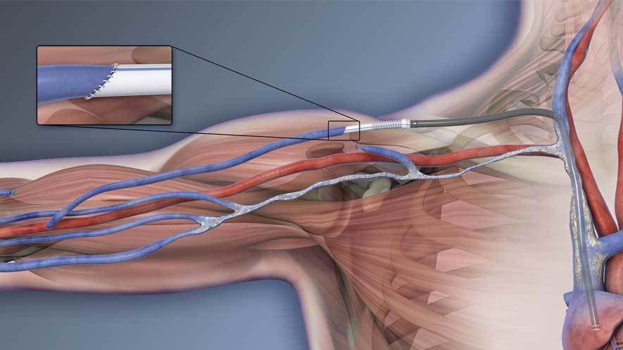 Read more about the article Global Hemodialysis Vascular Grafts Market Size, Share, Price, Trends, Growth, Analysis, Report and Forecast 2024-2032