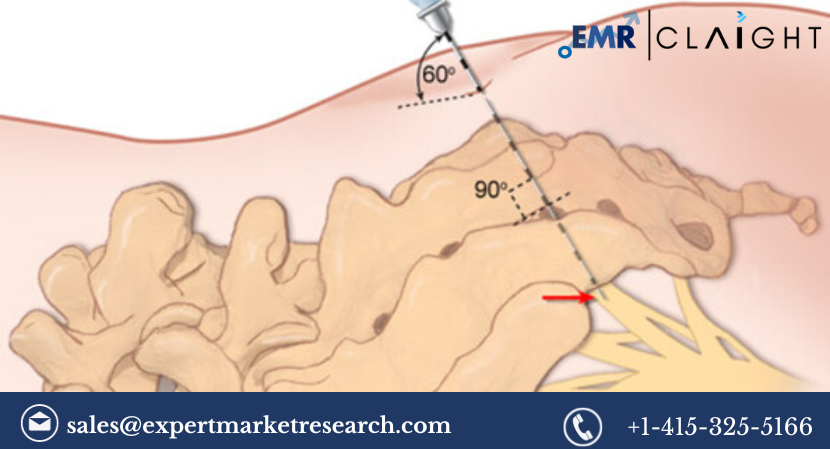 Read more about the article Sacral Nerve Stimulation Market Size, Share, Report and Forecast 2024-2032