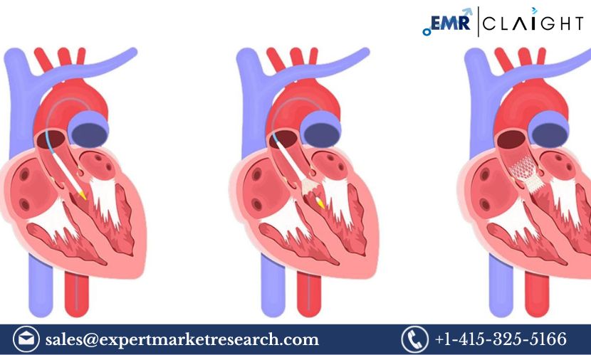 Read more about the article Global Transcatheter Heart Valve Replacement and Repair Market Size, Share, Price, Trends, Growth, Analysis, Report and Forecast 2024-2032