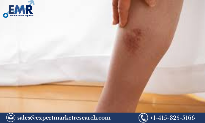 Read more about the article Acute Bacterial Skin and Skin Structure Infections Treatment Market Report and Forecast 2024-2032