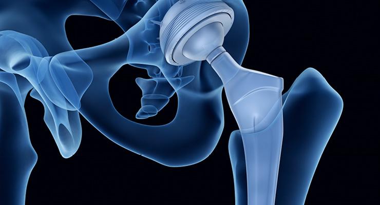 Read more about the article Global Orthopedic Digit Implants Market Size, Share, Price, Trends, Growth, Analysis, Report and Forecast 2024-2032