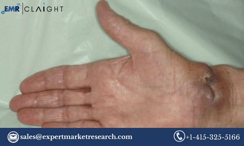 Read more about the article Synovial Sarcoma Market Size, Share, Report and Forecast 2024-2032