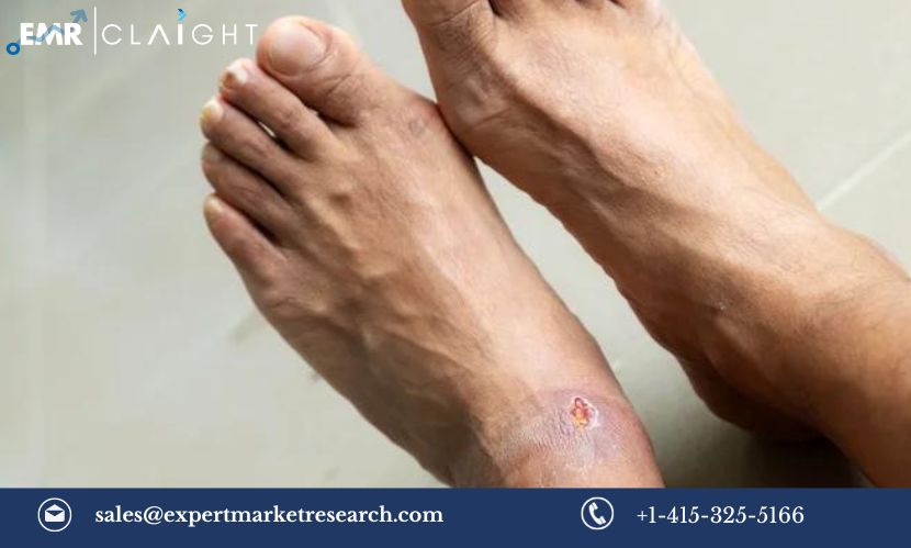 Diabetic Foot Ulcers Market Size, Share, Trends, Outlook, Growth ...