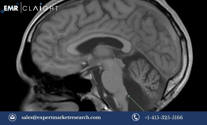 Read more about the article Ependymoma Market Size, Share, Trends, Growth, Report and Forecast 2024-2032