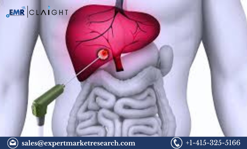 Read more about the article Asia Pacific Tumor Ablation Market Size, Share, Report and Forecast 2024-2032