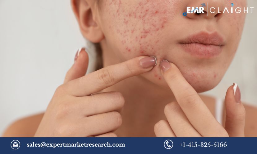 Read more about the article Global Severe Acne Vulgaris Treatment Market Size, Share, Growth, Trends & Analysis, Report and Forecast 2024-2032