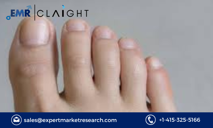 Read more about the article Onychomycosis Market Size, Share, Report and Forecast 2024-2032