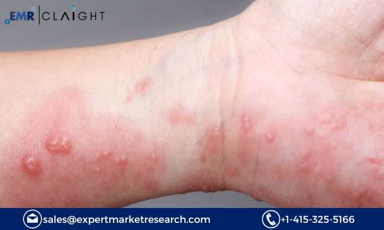 Read more about the article Bullous Pemphigoid Treatment Market Size, Share, Trends Report and Forecast 2024-2032