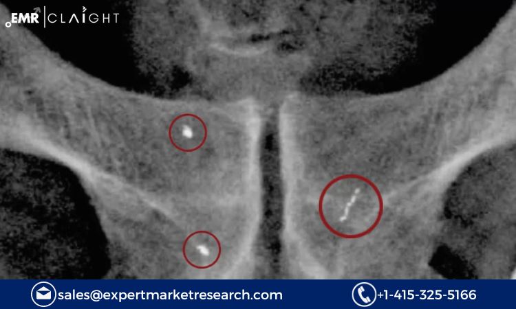 Read more about the article Global Fiducial Markers Market Size, Share, Trends, Growth, Report and Forecast 2024-2032