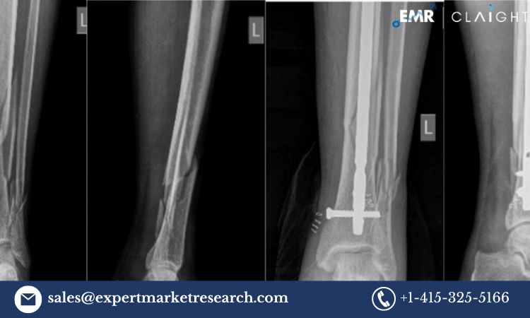 Read more about the article Global Intramedullary Nails Market Size, Share, Industry, Report and Forecast 2024-2032