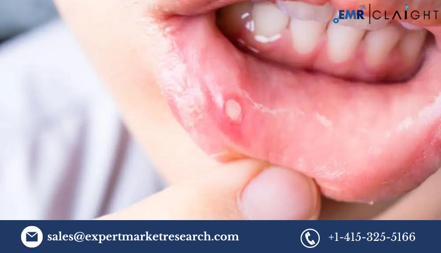 Read more about the article Mouth Ulcer Treatment Market Size, Share, Trends, Report and Forecast 2024-2032